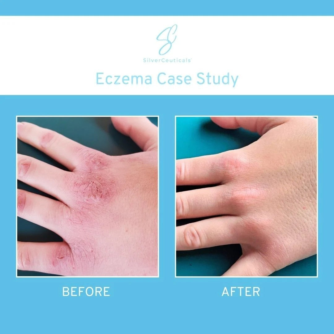 Eczema Therapy & Skin Relief Cream - 3.4 oz